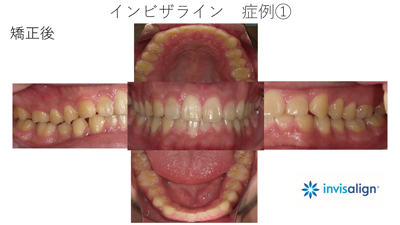 インビザライン　症例