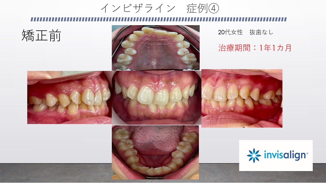 インビザライン症例