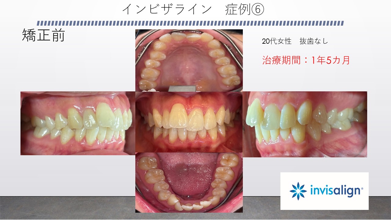 インビザライン症例