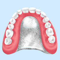 自費の入れ歯
