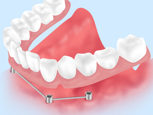 インプラントデンチャー