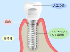 インプラント治療とは？