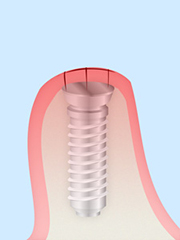 STEP4 治癒期間