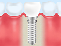 定期的なメインテナンスでインプラントを維持しましょう