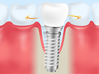 定期的なメインテナンスでインプラントを維持しましょう