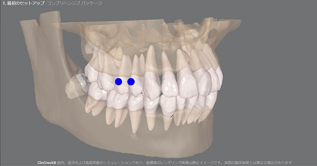 「Nemo」でより精度の高い矯正治療を実現