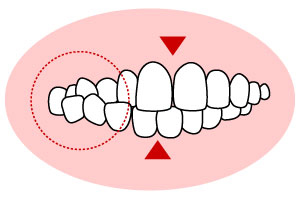 交叉咬合（こうさこうごう）