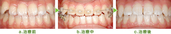 八重歯を改善するための矯正