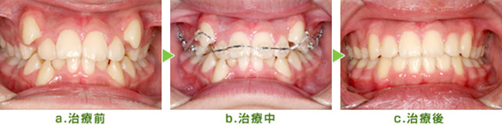 10代男性　八重歯と凸凹を改善するための矯正