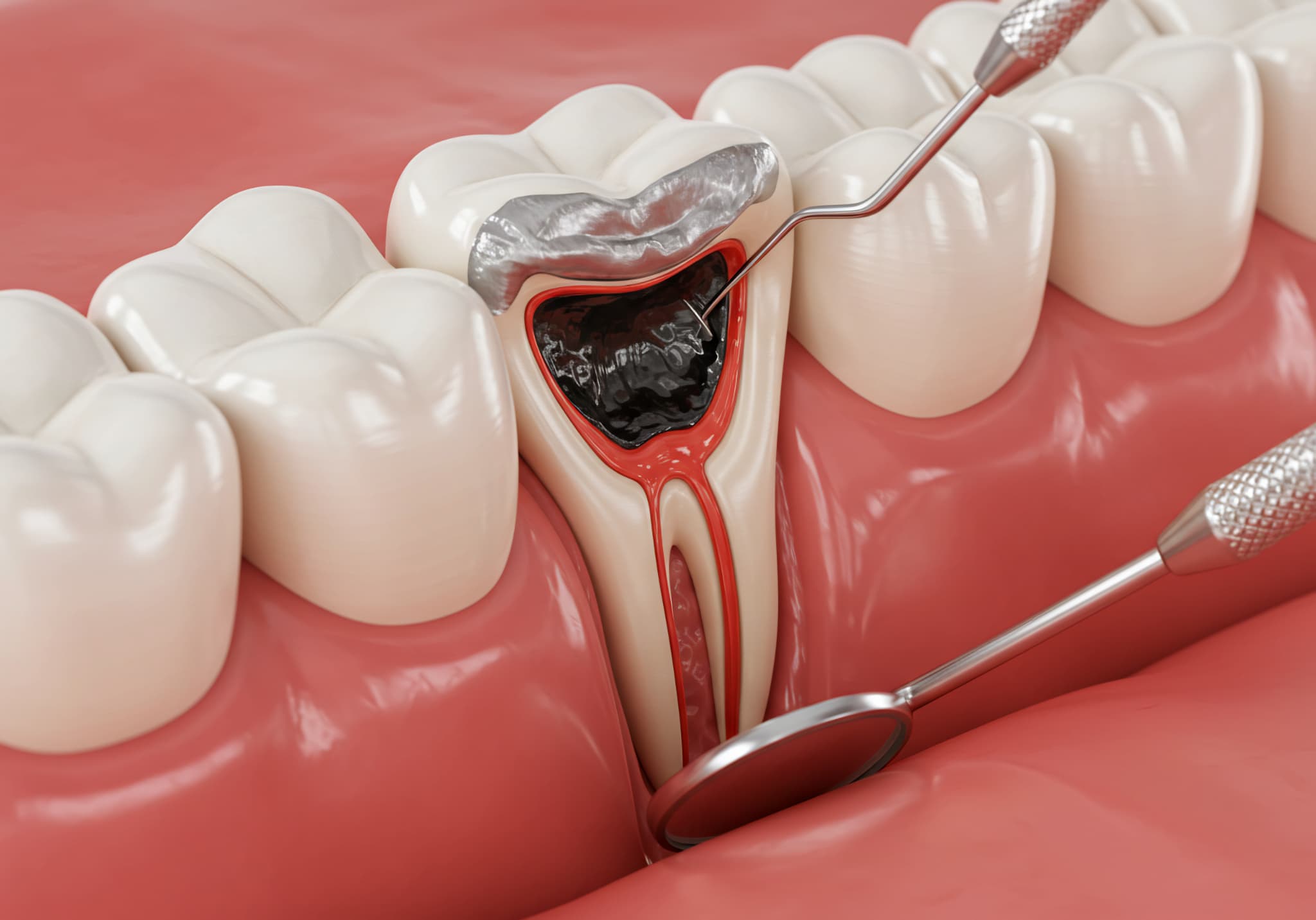 銀歯の下で虫歯が進行しているケース