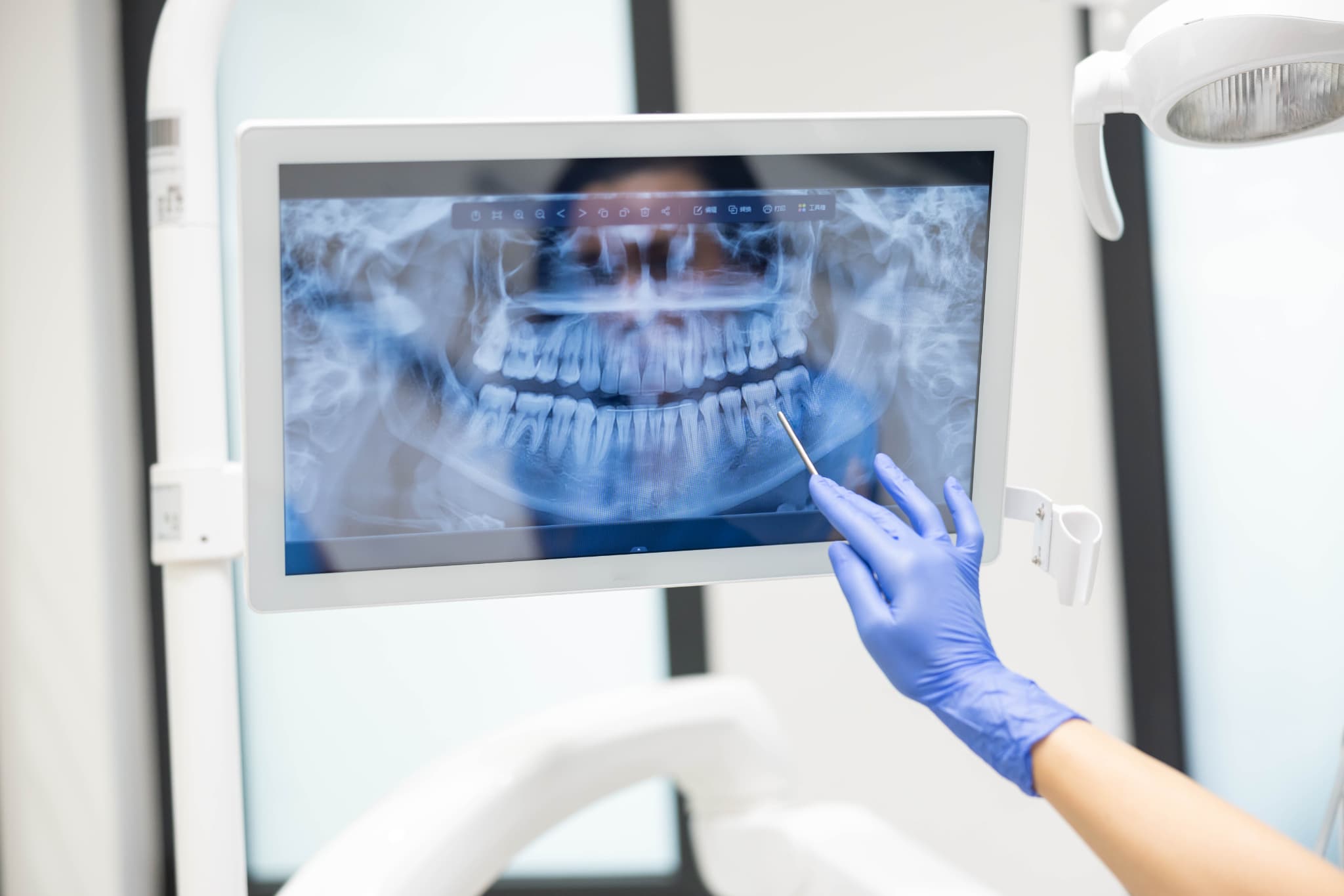 銀歯の下が虫歯になっていないか確認するためレントゲン撮影で確認する歯科医師