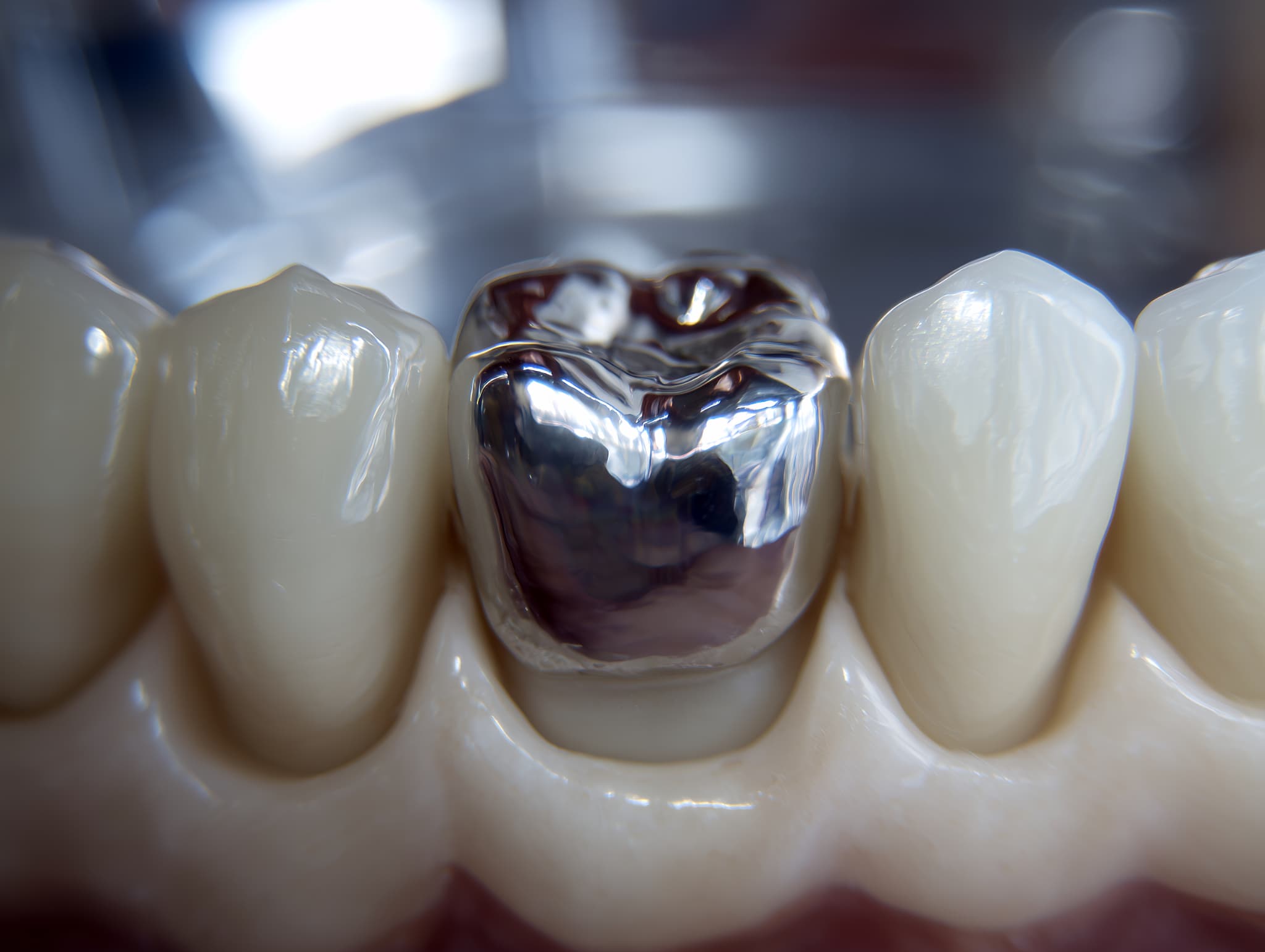 銀歯のイメージ